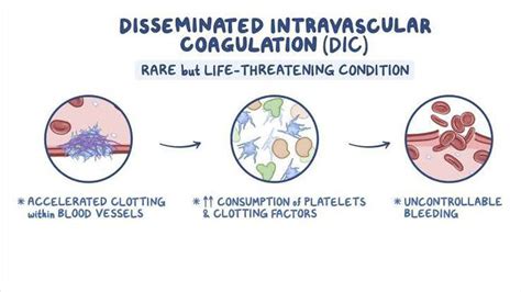 Disseminated Intravascular Coagulation Medizzy