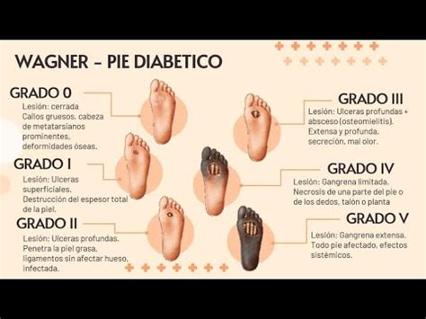 Clasificacion De Pie Diabetico Segun Wagner Youtube