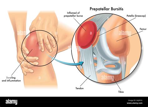 Medical Illustration Anatomie De Bursite Prepatellar Tat Du Genou