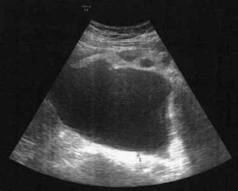 Presence of an adnexal mass at the ultrasound. | Download Scientific Diagram