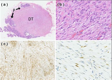 The Tumor Was Surrounded By Pancreatic Tissue Histological Findings Of