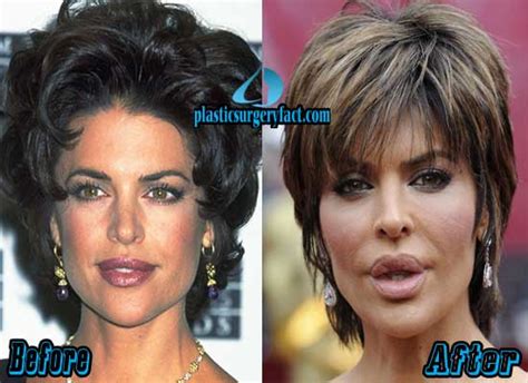 Lisa Rinna Plastic Surgery Before and After Photos