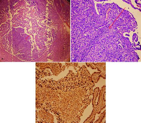 Histopathological Findings A High Grade Serous Adenocarcinoma In The Download Scientific