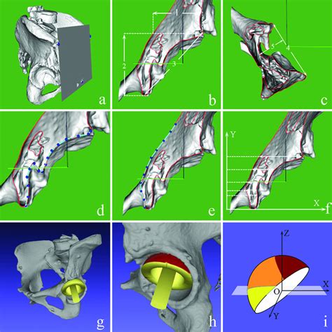 Acetabular Morphology Measurement And Simulating Implantation Of The