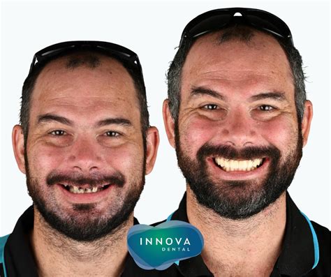 Check Out The Difference 🤩 Innova Dental Launceston Facebook