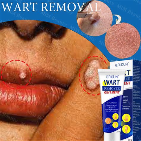 Sefudunsumifun Warts Remover Original Cream Painless Wart Remover