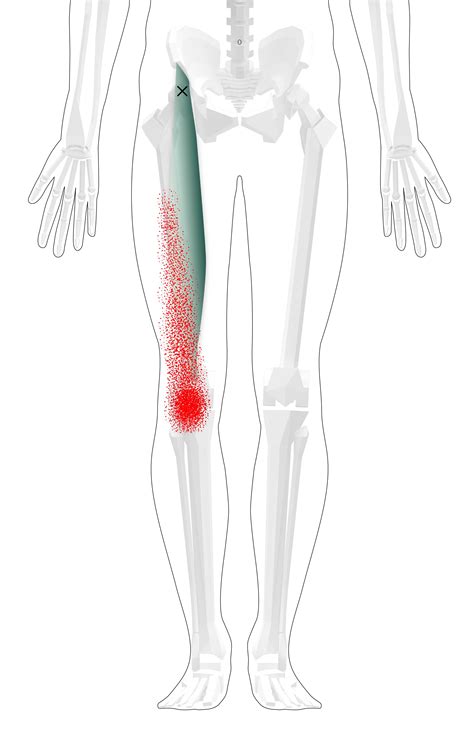 Iliopsoas Trigger Points (Overview and Tips for Self Treatment)