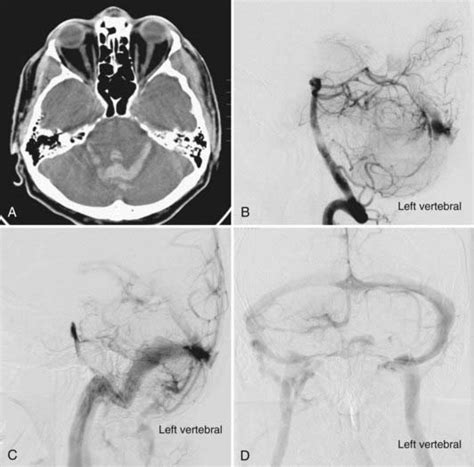 Pathobiology Of True Arteriovenous Malformations Neupsy Key