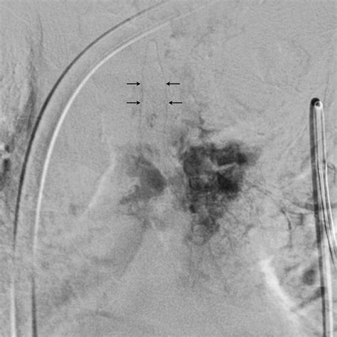 Angiography Via T Intercostal Artery Tumor Blush Is Visualized