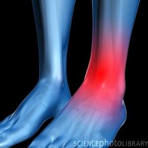 Swollen Ankles - Causes, Symptoms, Pictures and Treatment