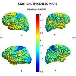 Cortical Maps Of Age Related Distribution Of Cortical Thickness In