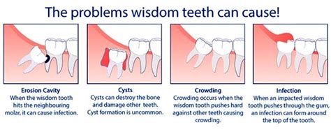 Wisdom Teeth Specialist Danville CA Kian Farzaneh DDS Oral Surgeon