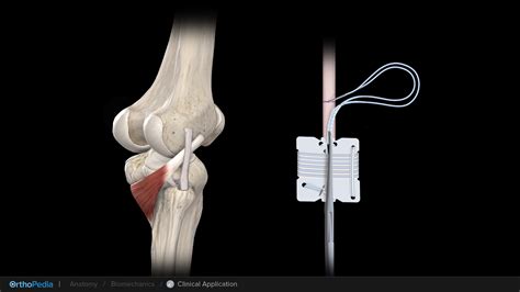 Knee Collateral Ligament Injury Posterolateral Corner Plc