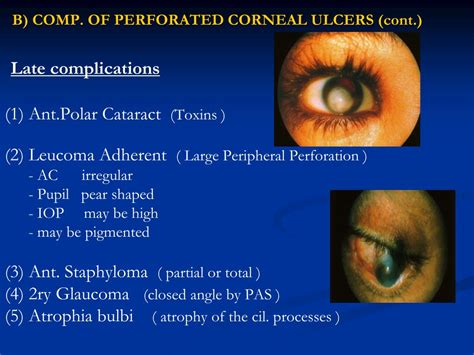 Ppt The Cornea Powerpoint Presentation Free Download Id4800497