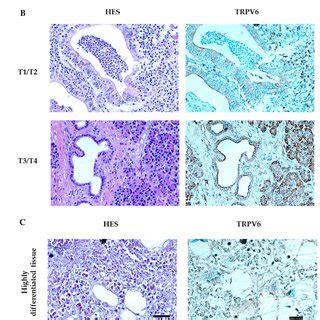 Trpv Expression Correlates With Pdac Staging Tissue Differentiation