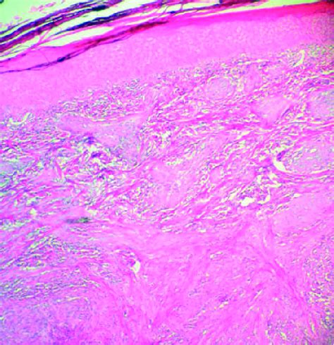 Interlacing Fascicles Of Spindle Cells Containing Eosinophilic