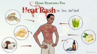 36 Home Remedies For Heat Rash On Face And Neck - page 3