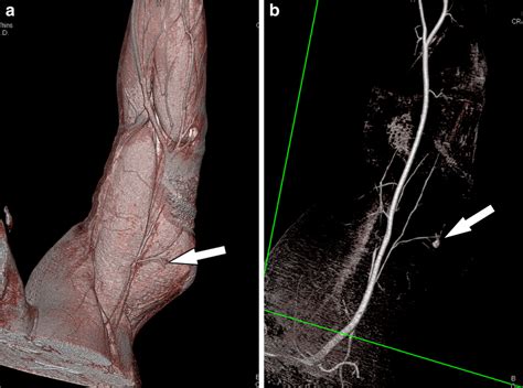 Active Extravasation MDCT Angiogram Of The Left Upper Extremity In