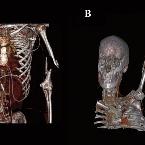 Pre And Postoperative 3d Reconstruction Of A Patient With A Download Scientific Diagram