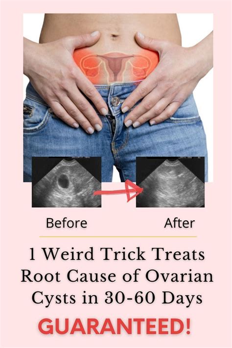 Get Rid Epidermoid Cysts Ovarian Cyst Epidermoid Cyst Cysts