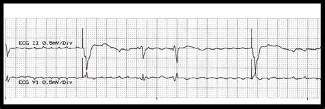 Float Nurse Ekg Rhythm Strips 23 Paced Rhythms