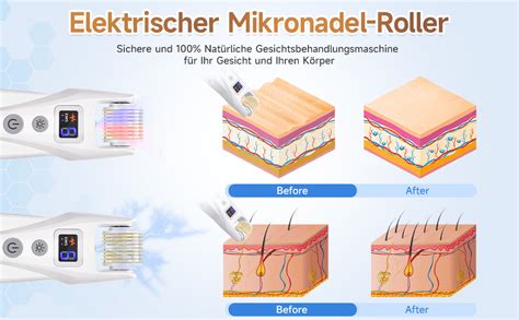 Yofuly Microneedling Roller Mit Echte Nadeln Elektrische Ems Derma