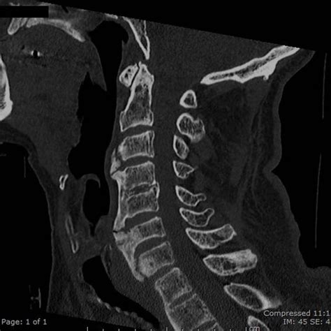 Broken Neck or Not - RCEMLearning India