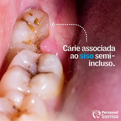 Cirurgia Dos Dentes Semi Inclusos Sisos Wanessa Paje