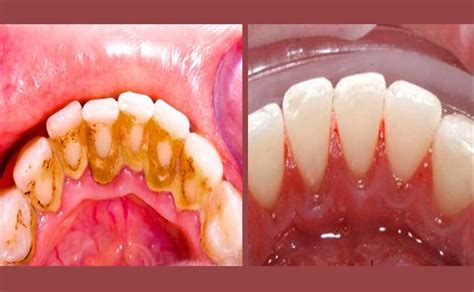 Placa bacteriana e tártaro livre se dos problemas dentários mais