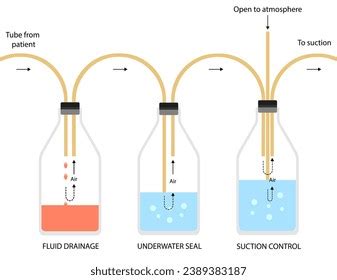 Three Bottle System Chest Tube Insertion Stock Vector (Royalty Free) 2389383187 | Shutterstock