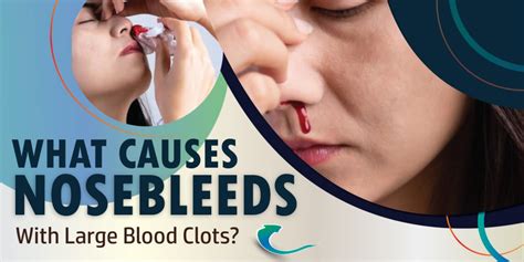 What Causes Nosebleeds with Blood Clots? | kayawell