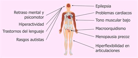 El Síndrome X frágil CURSO DE PEDIATRÍA Paradigmia