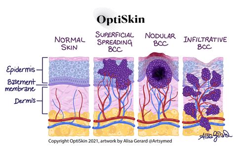 Basal Cell Carcinoma Dermatology Skin Cancer Experts