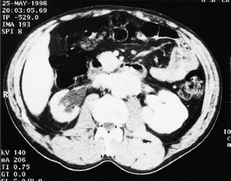 Ct Scan Showing Retroperitoneal Mass Causing Bilateral Urinary Tract Download Scientific