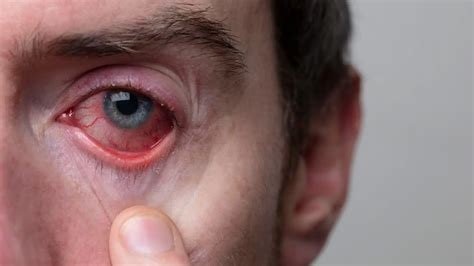 Understanding Conjunctivitis Causes Symptoms Prevention And