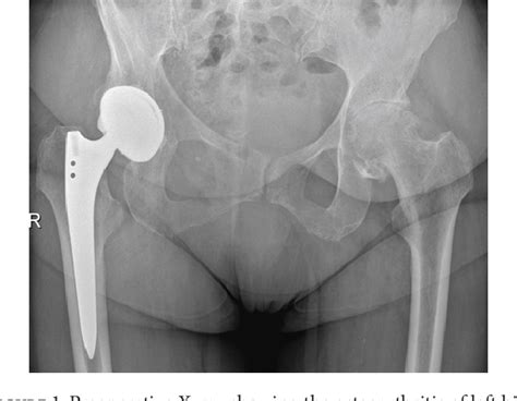 Figure From Delayed Femoral Nerve Palsy Associated With Iliopsoas