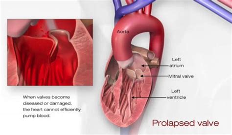 Mitral Valve Prolapse Florida Cardiology Pa