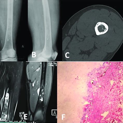 Dedifferentiated Chondrosarcoma Of The Left Distal Femur In A Download Scientific Diagram