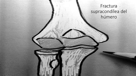 Fractura Supracond Lea Del H Mero Abraham D Vila Udocz