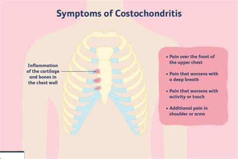 Costochondritis Cuase 症状 诊断 治疗 物理治疗 华体会体育手机端