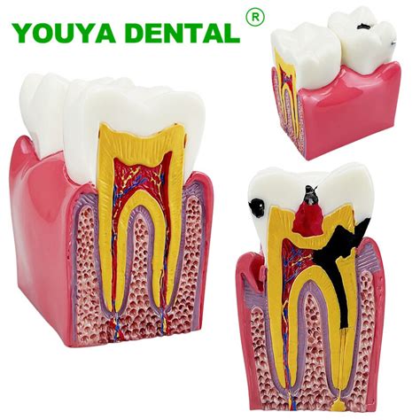 Dental Teeth Model Times Dental Caries Comparsion Study Models Tooth