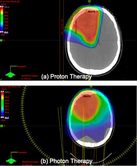 Comparison of dose distribution map of a proton therapy versus b photon ...