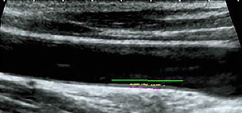 Measurement Index Longitudinal B Mode Us Image Using A Semi Automated