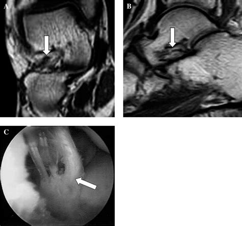 Sinus Tarsi Radiology