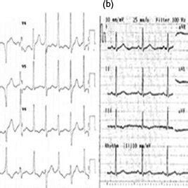 Twelvelead Electrocardiography Ecg Demonstrating A Polymorphic Vt