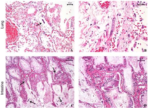 Histopathology Of Strongyloides Stercoralis In The Lungs And Intestine Download Scientific