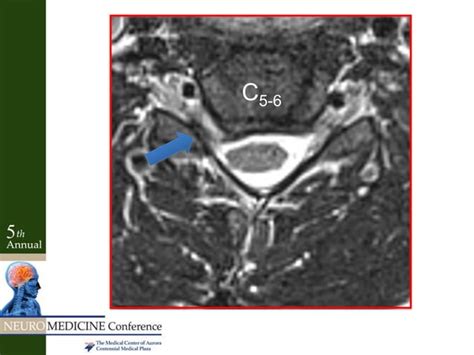 Radiculopathy Vs Peripheral Neuropathy Ppt