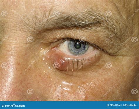 Sty in eye stock photo. Image of health, older, medical - 24160756