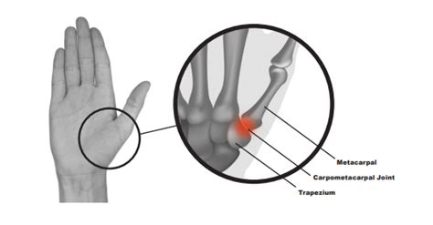 Base of thumb pain - Swansea Bay University Health Board