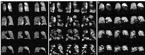 Ventilation Magnetic Resonance Imaging Sequences Using Hyperpolarized